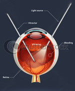 What is Cataract?